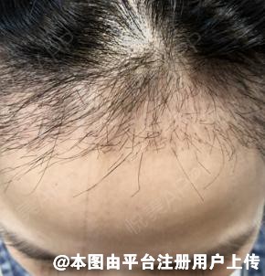 给大家分享如何治疗女性脱发-69