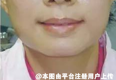 这老牌的医美项目除皱效果依旧神奇-4181