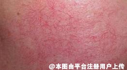 治疗色斑、痘坑和敏感的皮肤，要学会先后顺序去治疗