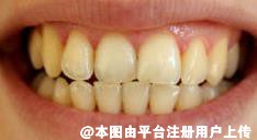 为什么牙齿总是黄黄的 原因原来是这样-5753