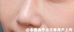 鼻头缩小的常见问题 不来看看吗