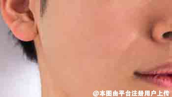35岁法令纹特别深不知道做热拉提需要几次才有效果