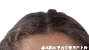 网红仿真发际线是怎么做的 哪里可以做这种超自然的发际线呢-10140