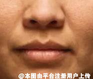 别再乱填充法令纹了 法令纹有不同成因及改善方法