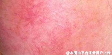 脸上有红血丝怎么办 这几点要注意