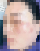 做完超皮秒后皮肤会不会越来越薄 效果会不会反弹
