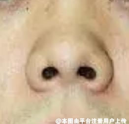 想挖鼻孔的注意了 这段时间不能挖鼻孔