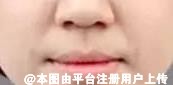 面中凹陷 你或许需要垫一下鼻基底