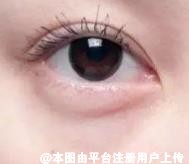 同样是去除眼袋 为什么吸脂去眼袋就不会复发