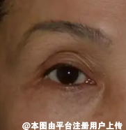 若是眼部皮肤松弛厉害 可以做个提眉