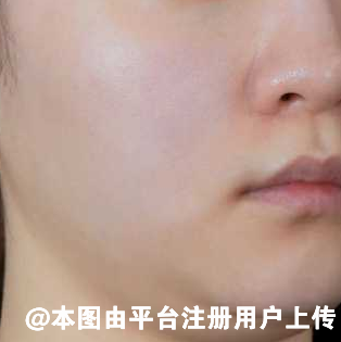 面部吸脂的全过程是如何的呢 吸脂后肌肤是否会松驰