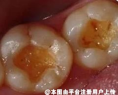 不要要趁早 牙病切忌久拖不治