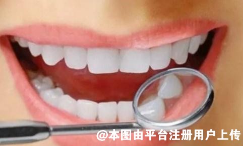 洗牙是自费还是医保卡 洗牙价格是多少钱