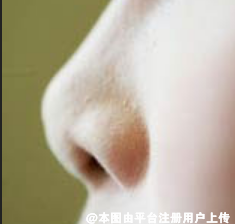 朝天鼻是一种比较常见的鼻部畸形  朝天鼻该如何矫正呢