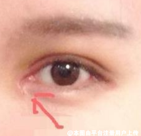 开眼角术后为眼角为什么会回缩呢
