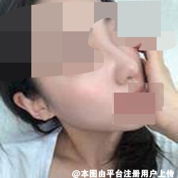 鼻子恢复的很快 高挺的鼻梁衬托的五官立体-24220