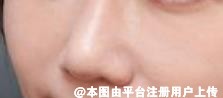 想做自体软骨隆鼻 但耳软骨和肋软骨有什么区别呢