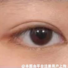 跟双眼皮比起来 眼综合又多了哪些项目呢