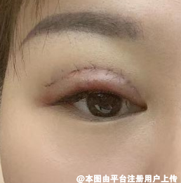 你对自己的眼睛满意吗 双眼皮手术如何避免出现肉条呢