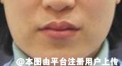 法令纹的消除 热玛吉和埋线提升的侧重点不同