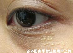 眼睛周围长满脂肪粒 用这3种方法可以改善-24673