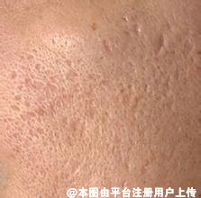 毛孔粗大显得皮肤坑坑洼洼的 我们该如何改善呢