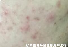 4种医美祛痘方式大测评 让你一次了解清楚