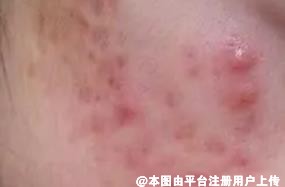 生活习惯对于痤疮的影响也不可忽视