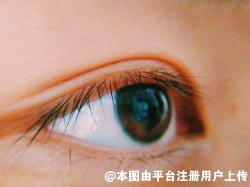 本想开开心心拉个双眼皮 可术后却出现了难看的肉条