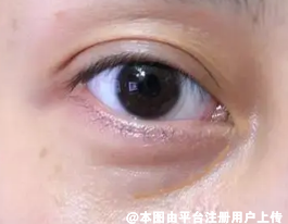 泪沟显老又难看 怎么去泪沟呢