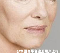 面部除皱方法有很多 热拉提和热玛吉该怎么选择