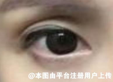导致眼窝凹陷的原因有哪些 该如何改善呢