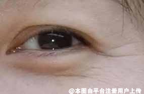 涂了眼霜眼纹为何还是越来越多 医美如何改善眼周衰老-25477