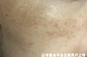 一生要强的女人 怎么能让脸上的斑点拉低颜值呢