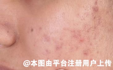 做完光子嫩肤后脸部出现爆痘现象 该怎么处理