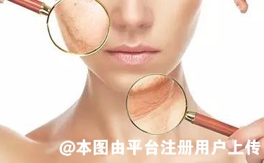 皮秒打完不结痂是不是代表白打了 这些细节要注意