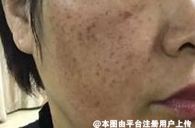 谁说夏季不可以祛斑的 不管是哪个季节都可以祛斑-25788