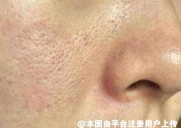 不同的毛孔粗大类型 用不同的方式才能事半功倍