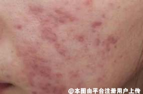 青春不在青春痘还在 成年人的该如何祛痘印呢