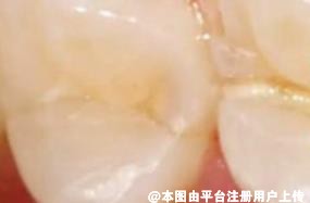 关于一些根管治疗的疑问 这里统统告诉你