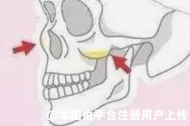 颧骨太宽怎么改善？颧骨太宽可以选择做磨骨手术