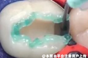补牙要趁早 不能错过好时机-25947