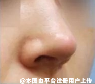 鼻子是面部的一个重要部分 隆鼻后这几点要注意