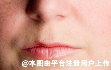 脂肪填充法令纹好几天了都没有效果是失败了吗