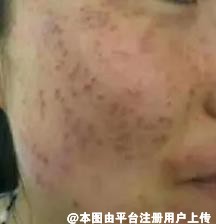 为什么要选激光来祛斑