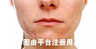 光子嫩肤做完真的会爆痘吗 术后该怎么护理才好