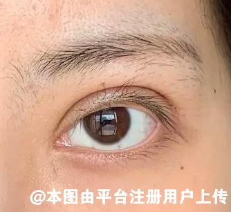 你知道为什么双眼皮修复那么贵吗