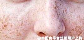 脸上莫名长了好多痘疤 做激光治疗效果明显吗