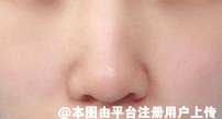 为啥整形后 你的鼻型看起来有点假