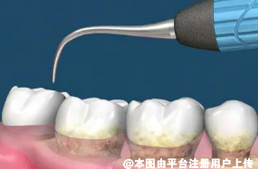 去除牙结石保持牙龈健康状态 牙齿不是越洗越松